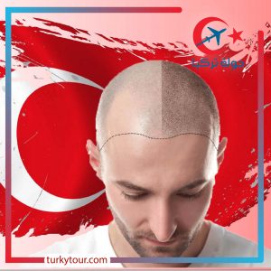 زراعة الشعر في تركيا