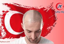 Photo of زراعة الشعر في تركيا